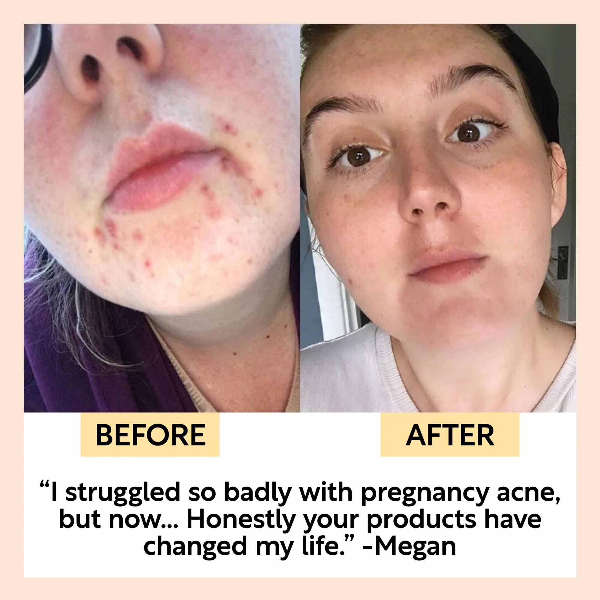 UpCircle The Acne-Prone Bundle - Image 7